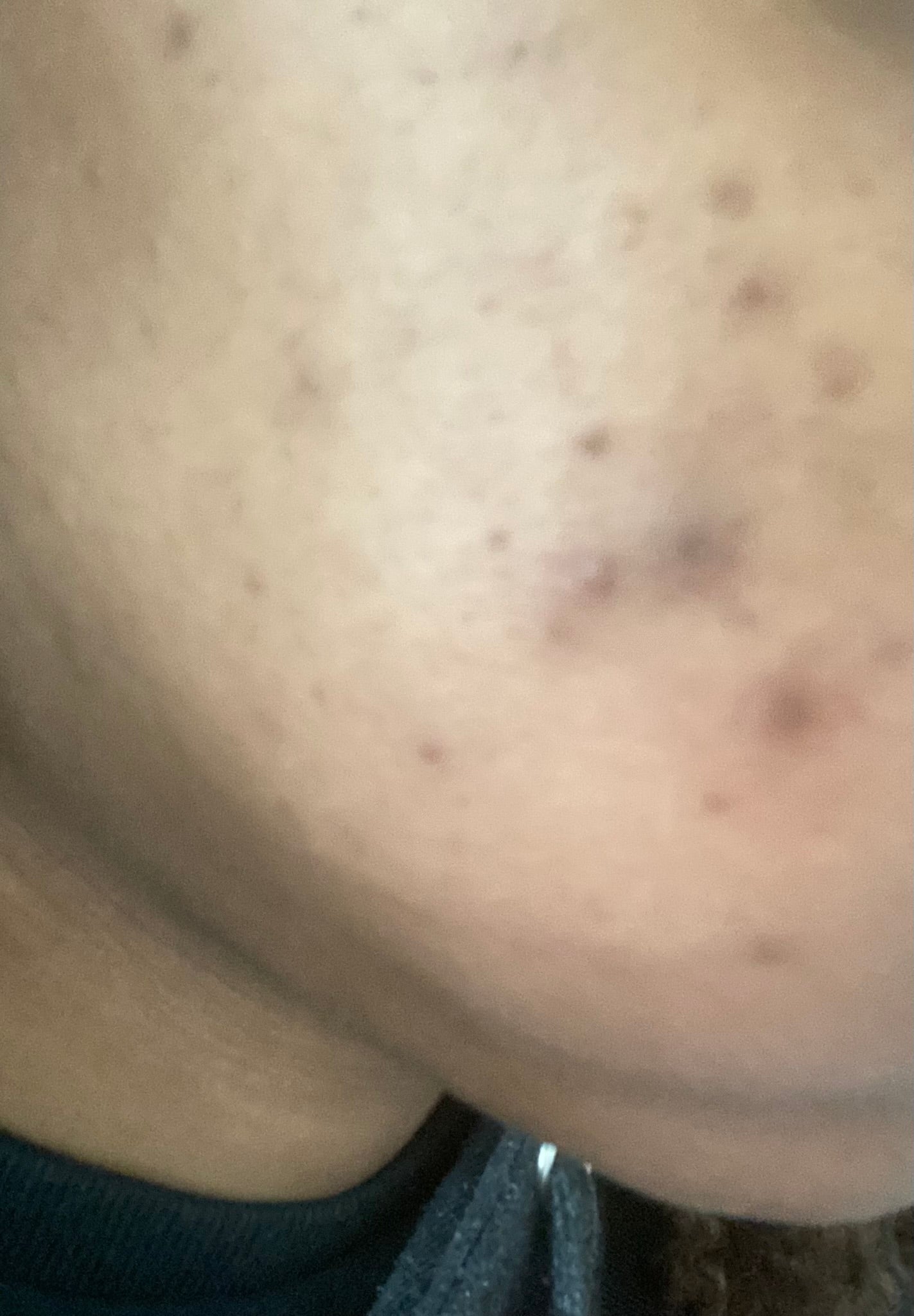 Revitalizing Cleanser: Acne Prone Skin