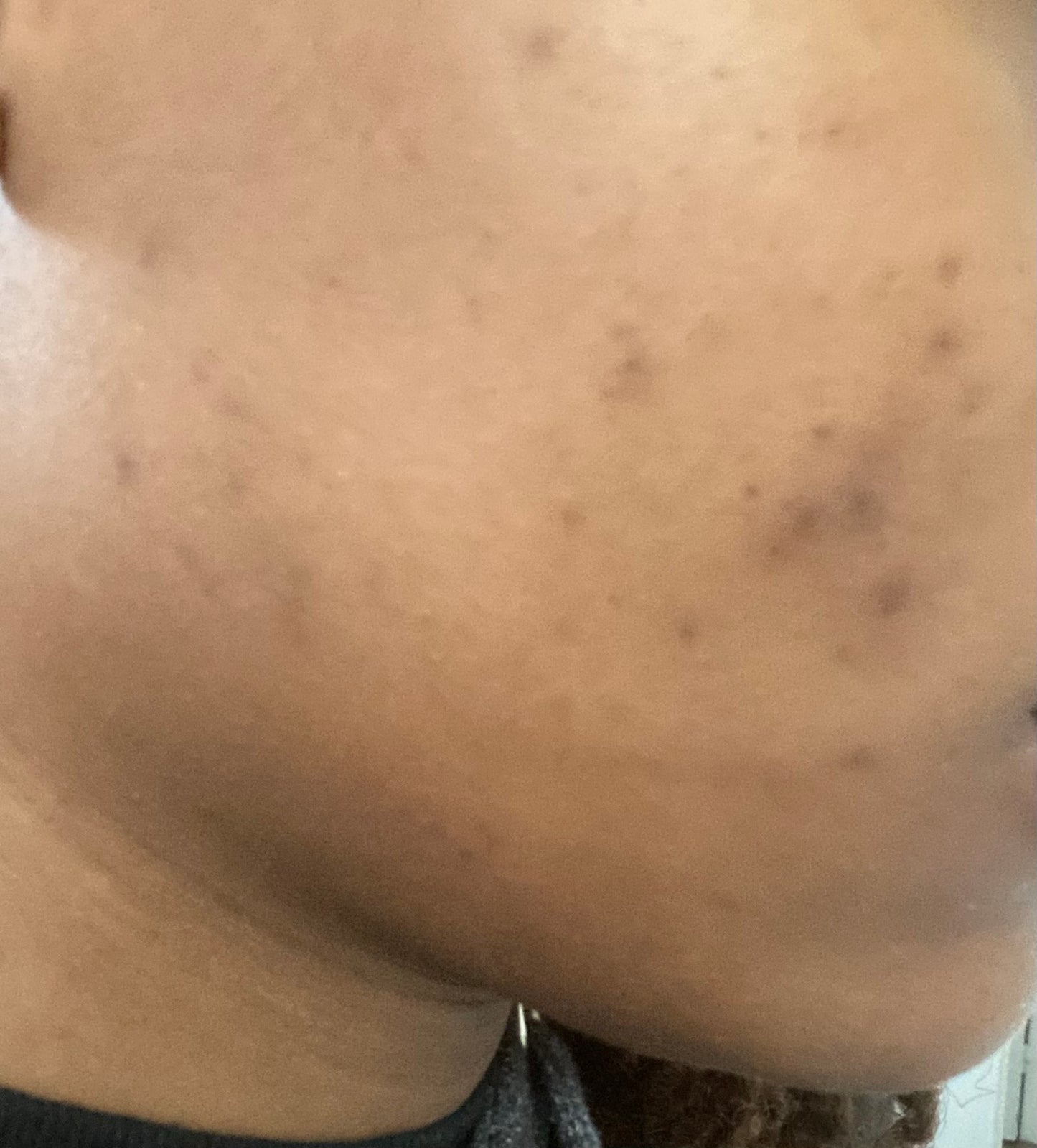 Revitalizing Cleanser: Acne Prone Skin