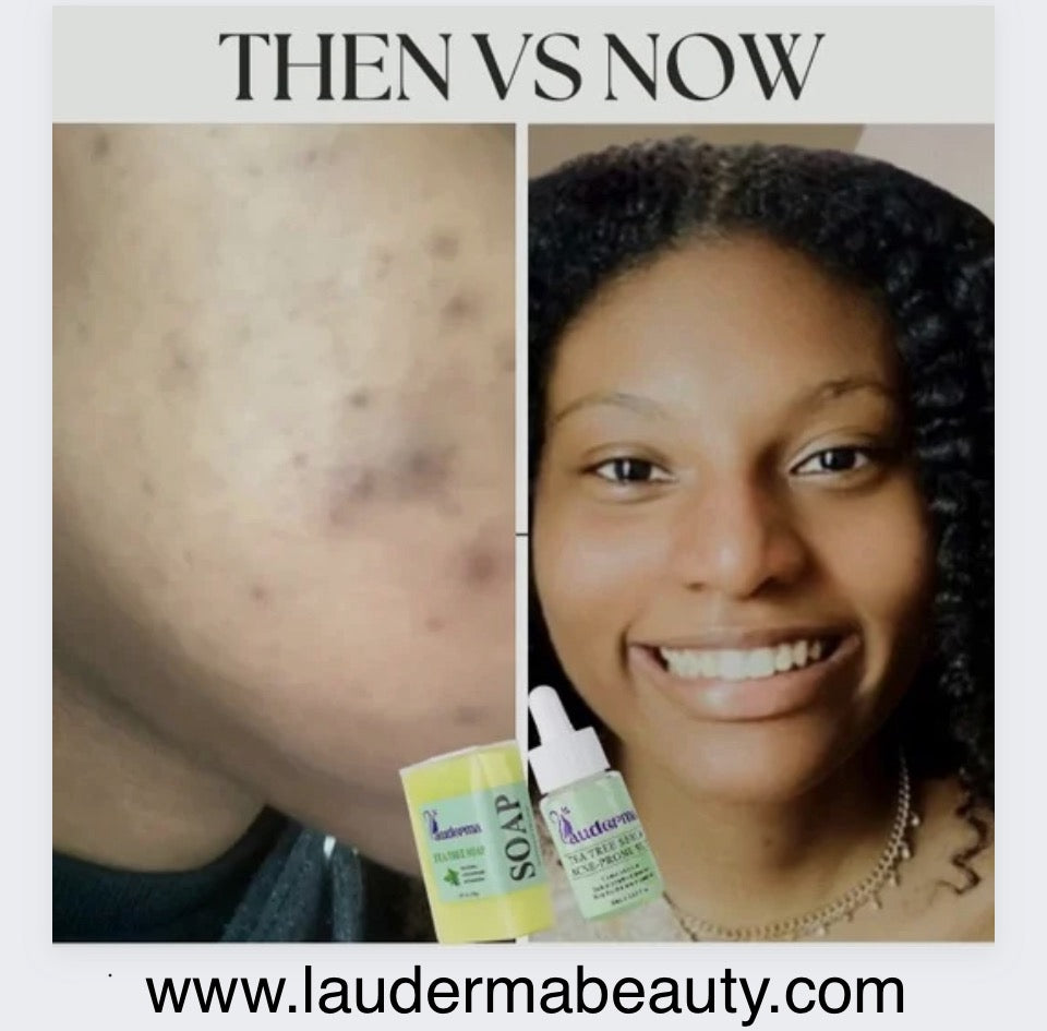 before and after image showing acne pimples that have now faded away