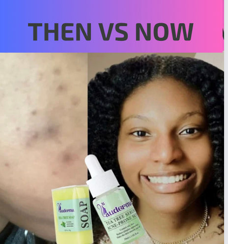 image of a lady with improving acne scars after usingThe Best Facial Serum For Acne Prone Skin