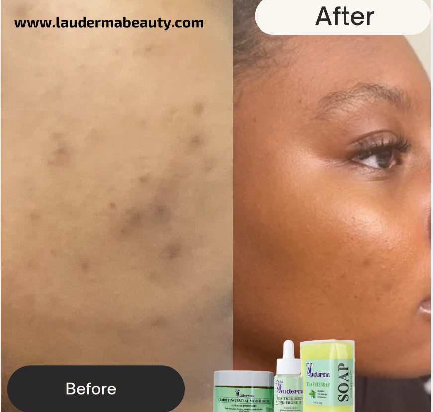 Extreme Clarifying Acne-Prone Bundle